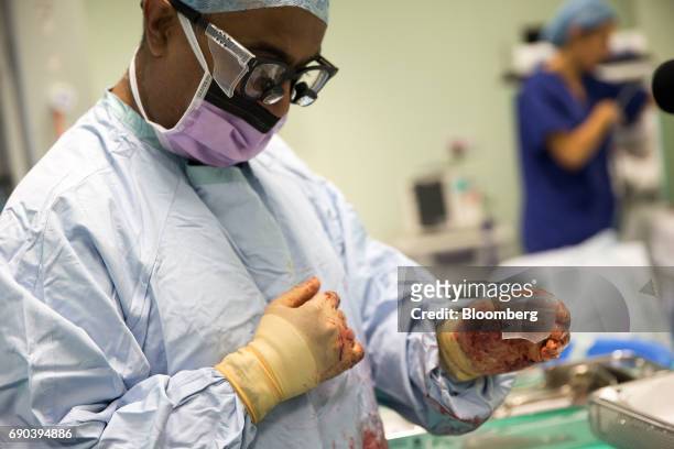 Satyesh Parmar, consultant oral and maxillofacial surgeon, holds a plastic plate as he performs a facial reconstruction operation to move part of a...