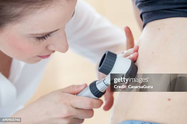 dermatologist inspecting patient skin moles - melanoma stock pictures, royalty-free photos & images