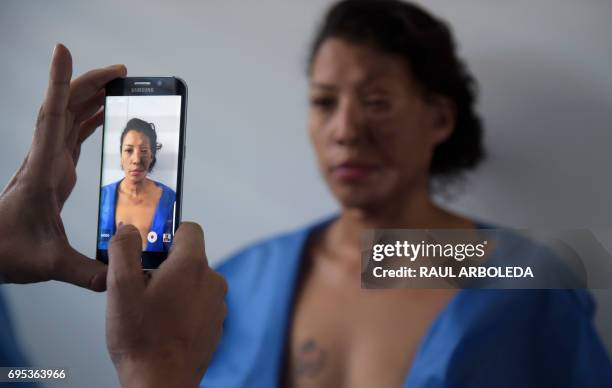 Colombian doctor Alan Gonzalez takes a picture of 32-year-old Angeles Borda, who survived an acid attack ten years ago, in his office prior to her...