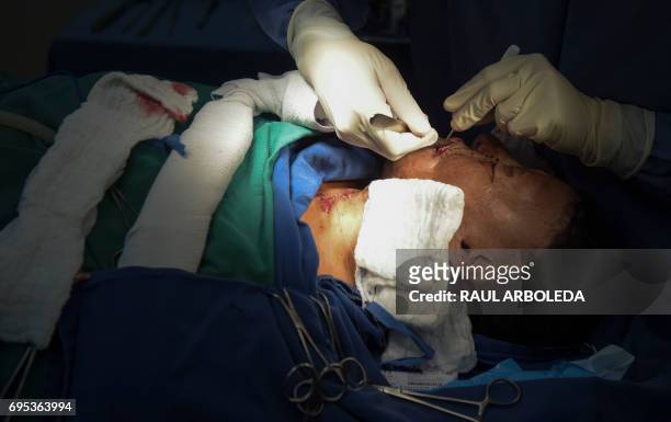 Colombian doctor Alan Gonzalez operates on 32-year-old acid attack survivor Angeles Borda in Bogota, Colombia on May 30, 2017. Dr. Alan Gonzalez is a...