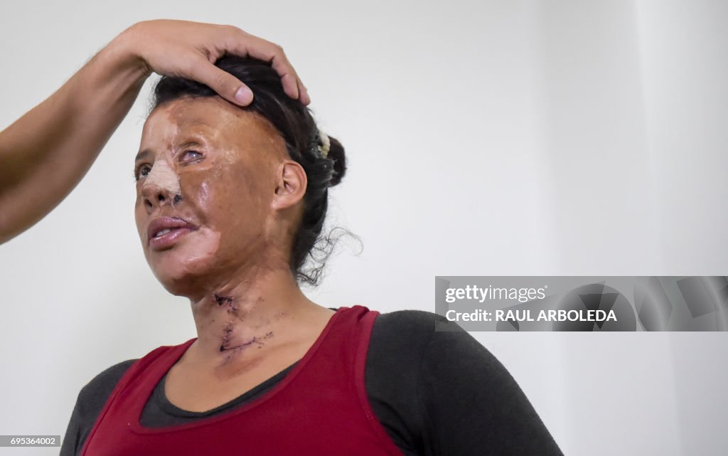 COLOMBIA-VIOLENCE-WOMEN-ACID-PLASTIC SURGERY