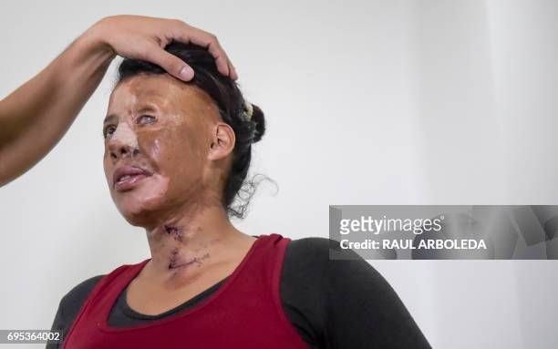 Colombian doctor Alan Gonzalez examines acid attack survivor Angeles Borda in Bogota, Colombia on June 7, 2017. Dr. Alan Gonzalez is a Colombian...