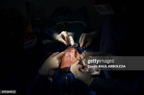 Colombian doctor Alan Gonzalez operates on 32-year-old acid attack survivor Angeles Borda in Bogota, Colombia on May 30, 2017. Dr. Alan Gonzalez is a...