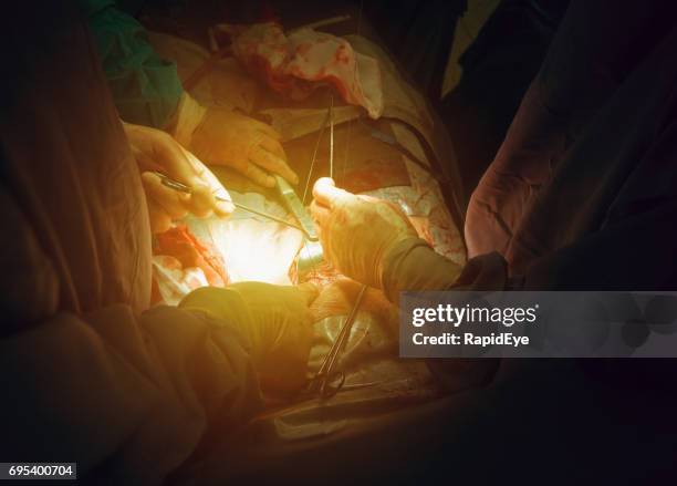 overhead view of operating room where surgery is taking place - retractor stock pictures, royalty-free photos & images