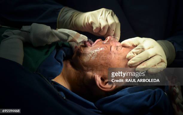 Colombian doctor Alan Gonzalez gets ready to operate on 32-year-old acid attack survivor Angeles Borda in his surgery in Bogota, Colombia on May 30,...