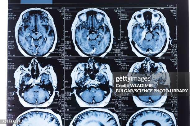 mri scans of the human brain - medical scanner fotografías e imágenes de stock