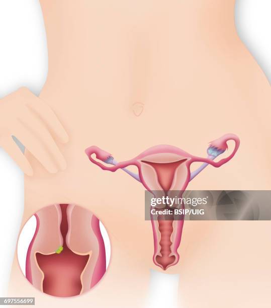 cervical cancer, drawing - uterine wall stock pictures, royalty-free photos & images