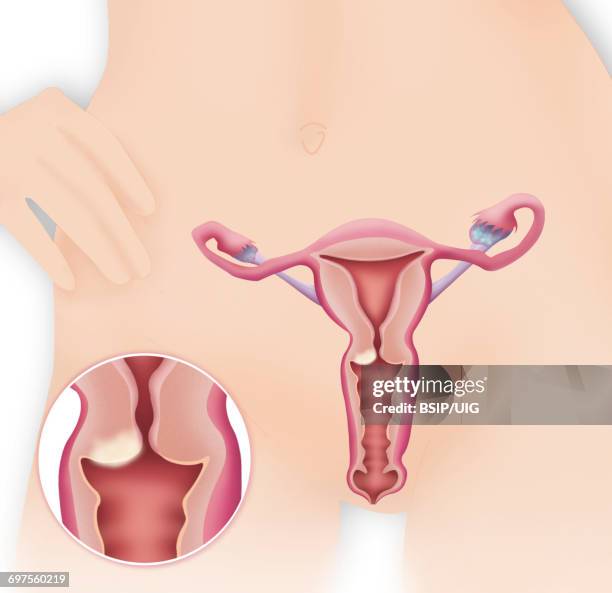 cervical cancer, drawing - uterine wall fotografías e imágenes de stock