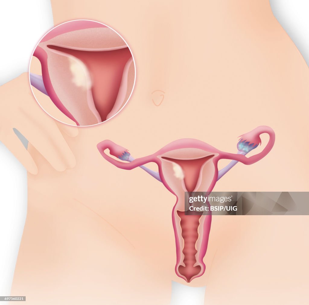 Cancer endometrium, drawing