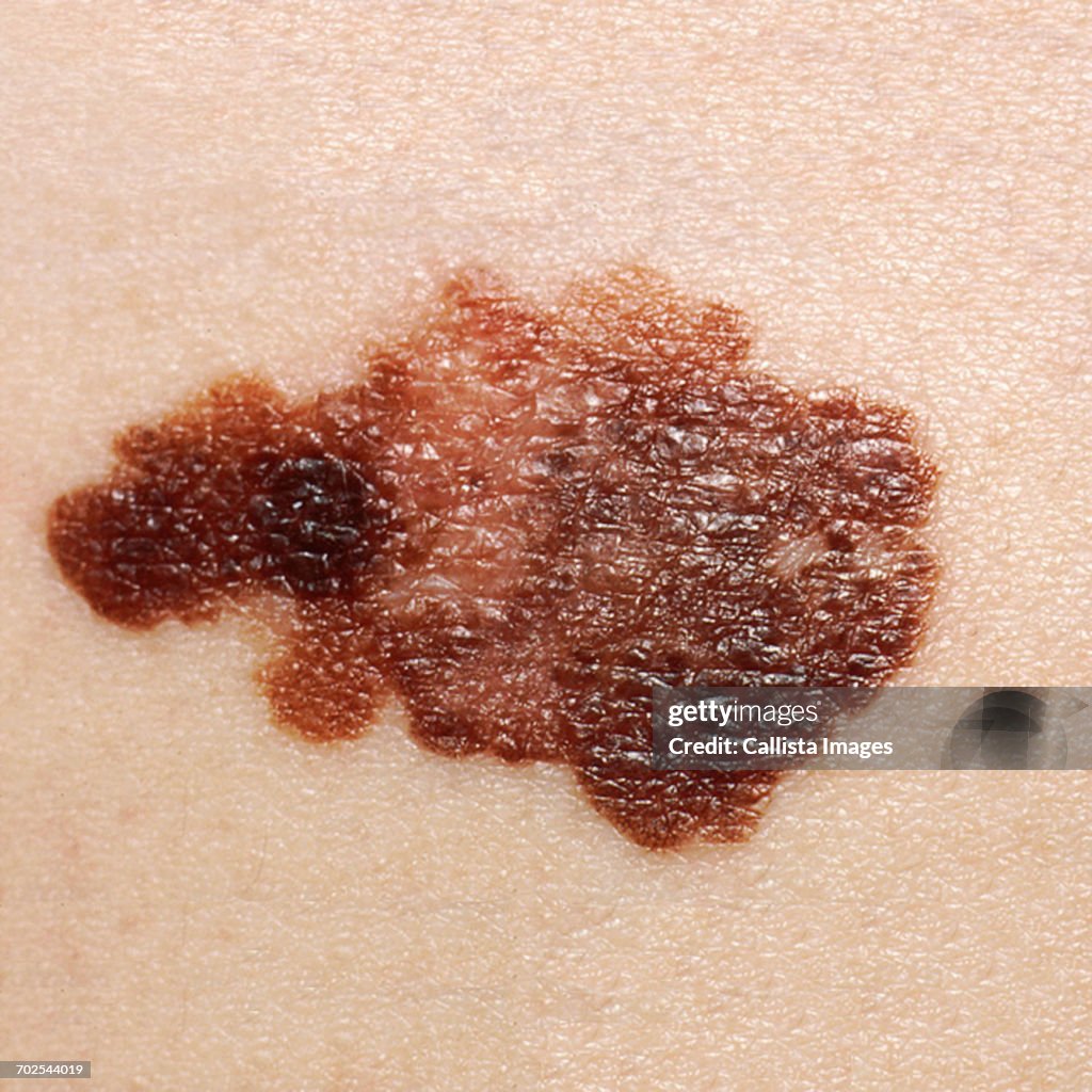 Close up of skin cancer
