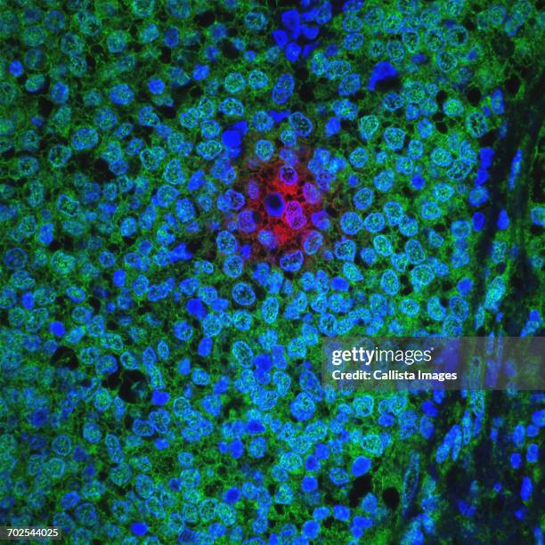 microscopic image of breast cancer cells resisting treatment - cancer 2016 stock pictures, royalty-free photos & images