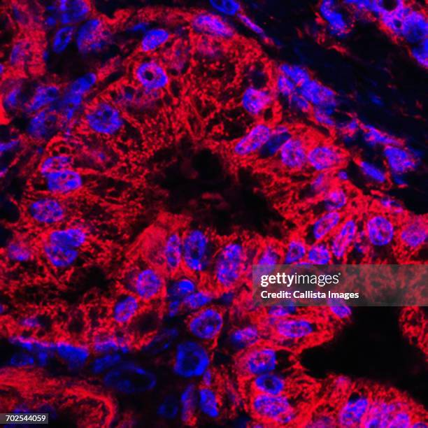 microscopic image of mitochondrial stained pancreatic cancer cells - pancreatic cancer stockfoto's en -beelden