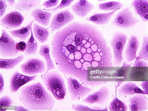 koilocytes, squamous epithelial cells, altered by human papillomavirus - virus del papilloma umano foto e immagini stock