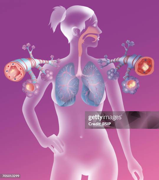 asthma, drawing - copd stock illustrations