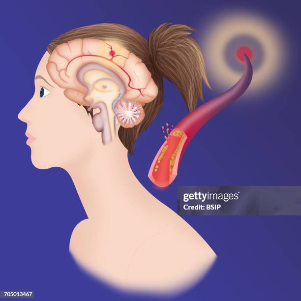 cerebrovascular neurol. disease - ischemic stroke stock illustrations