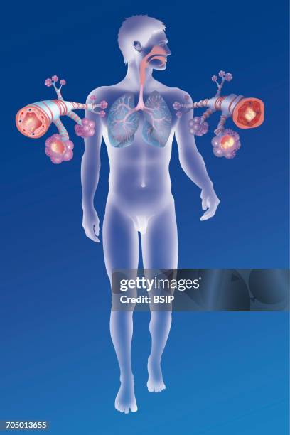 asthma, drawing - copd stock illustrations