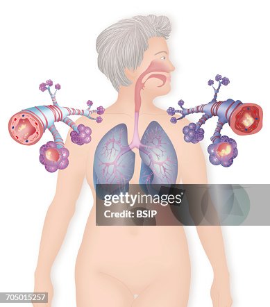 Asthma, drawing Asthma, drawing