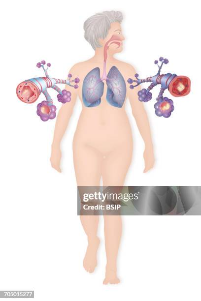 asthma, drawing - copd stock illustrations