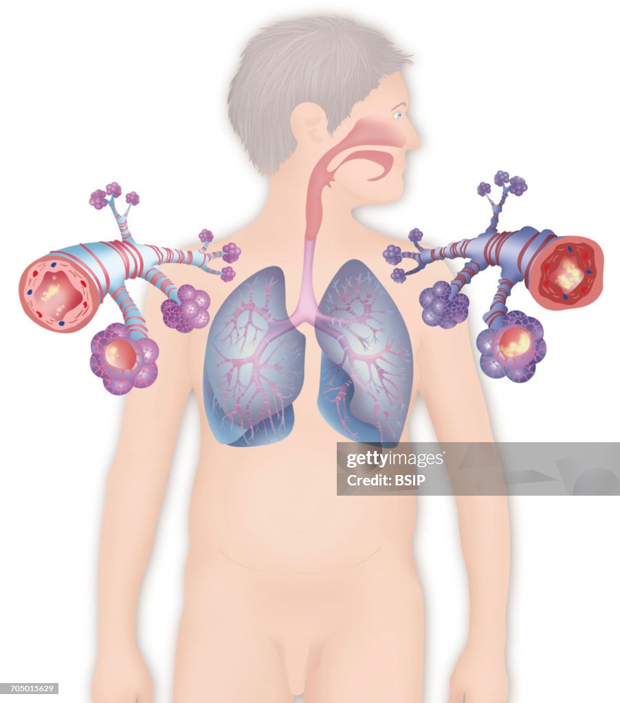 Asthma, drawing