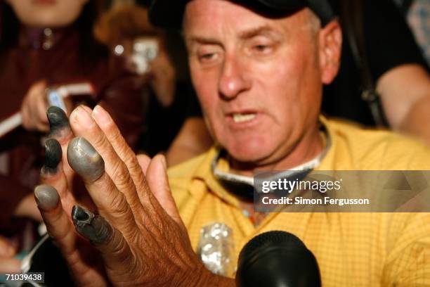 New Zealand climber Mark Inglis, a double-amputee, shows the media his badly frost bitten hands upon arriving at Christchurch airport, after...