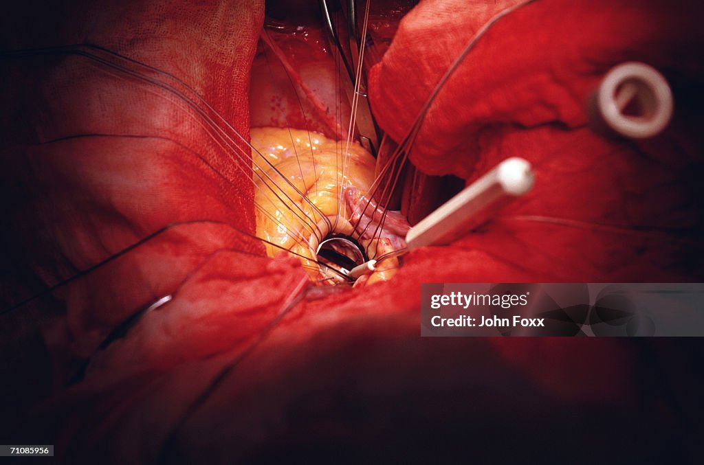 Open-heart surgery