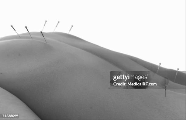 acupuncture needles applied to a woman's back - acupuncture stock illustrations
