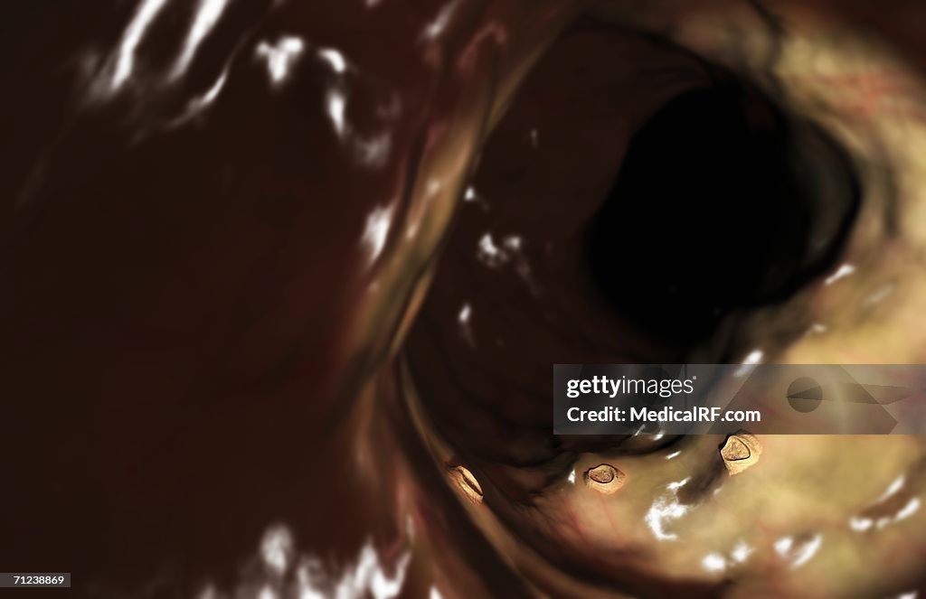 Aphthous ulcers