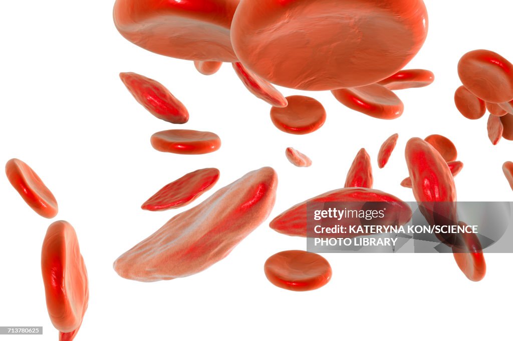 Sickle cell red blood cells, illustration