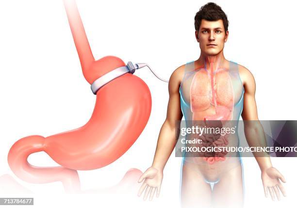 ilustrações de stock, clip art, desenhos animados e ícones de adjustable gastric band, illustration - gastric band treatment