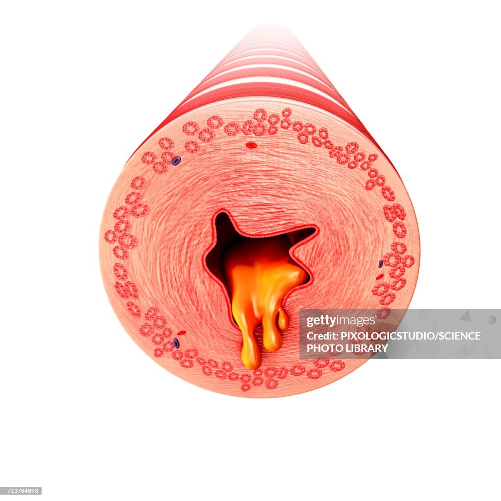 Bronchus with excess mucus, illustration