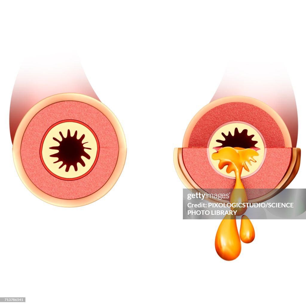 Normal and infected bronchi, illustration