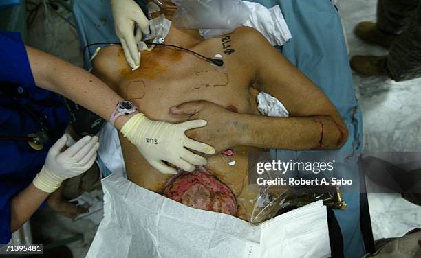 Army Dr. Robert Mazur, a native of Huntington, Long Island, and his trauma staff work on an Iraqi soldier shot in the stomach with a bullet lodged in...