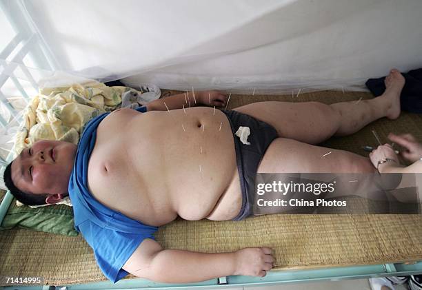 Child attending a weight-loss summer camp organized by the Aimin Slimming Centre, receives acupuncture treatment July 11, 2006 in Wuhan of Hubei...