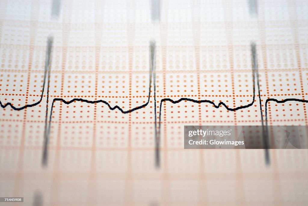 Close-up of an ECG report