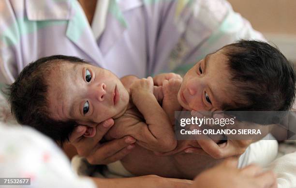 Guatemala City, GUATEMALA: One-month-old cojoined twins Angela Corina and Angela Leticia are pictured at the Roosevelt Hospital in Guatemala City,...