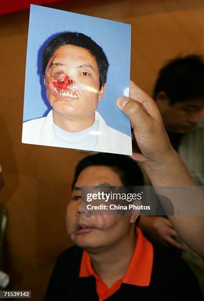 Doctor displays the picture of Li Guoxing, China's first face transplant patient, taken before his transplant surgery at a press conference on July...
