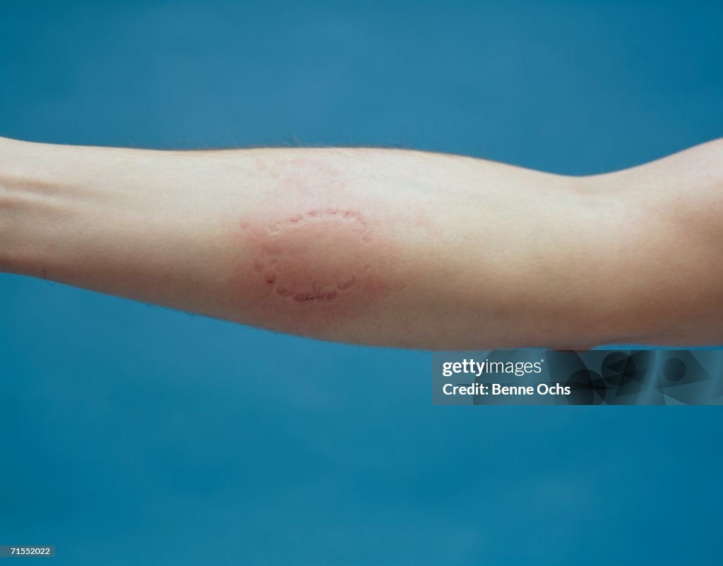 Human arm with bite mark