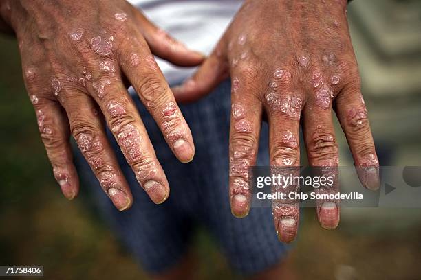 Republic of Korea Armed Forces veteran Wong Sup Um, 59 of Seoul, who suffers from skin lesions that he says is due his exposure to Agent Orange while...