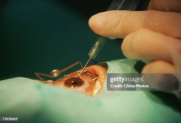 Doctor carries out a laser eye surgery, which utilizes computer-controlled excimer laser to correct myopia, at an ophthalmology clinic on September...