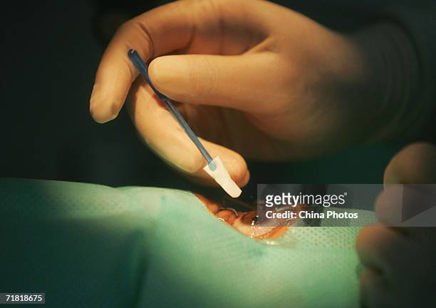Doctor carries out a laser eye surgery, which utilizes computer-controlled excimer laser to correct myopia, at an ophthalmology clinic on September...