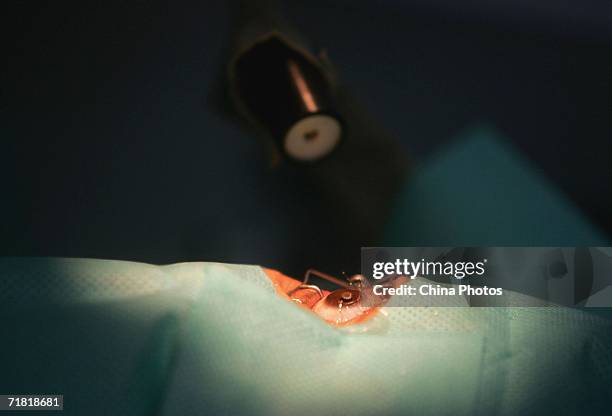 Computer-controlled excimer laser in operation during a laser eye surgery, which utilizes excimer laser to correct myopia, at an ophthalmology clinic...