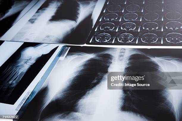 chest x-ray and mri scans - brustkorb stock-fotos und bilder