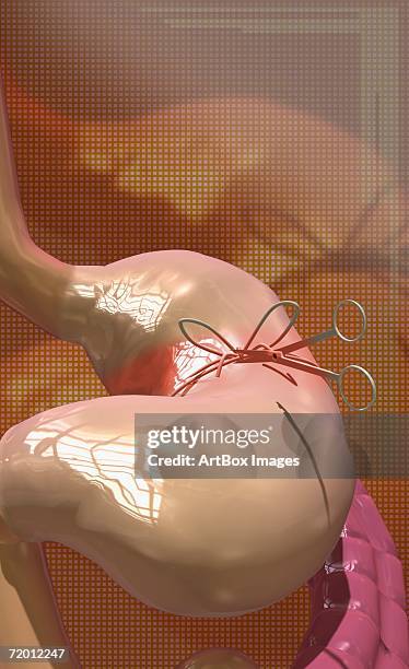 stockillustraties, clipart, cartoons en iconen met surgical scissors cutting thread around a human stomach - menselijke twaalfvingerige darm