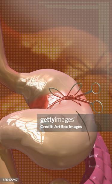 surgical scissors cutting thread around a human stomach - human duodenum stock illustrations