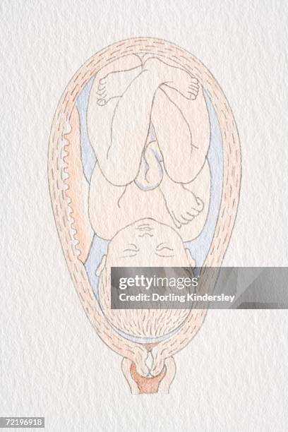 swollen womb with inverted foetus' head pointing to cervix opening. - cervix stock illustrations