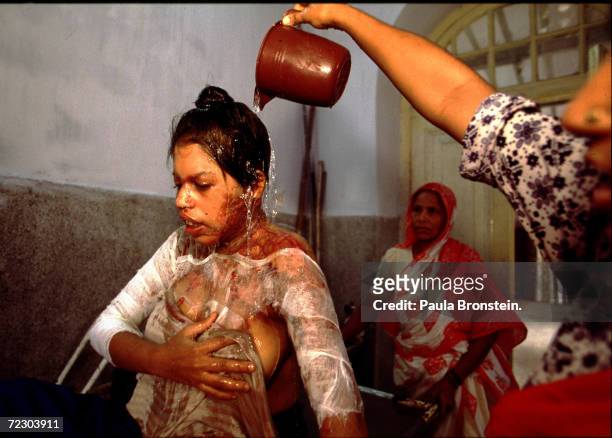 Reba, a 19 year-old Bangladeshi woman suffering severe burns from a battery acid attack, rinses her wounds, July 2000 in Dhaka, Bangladesh with the...