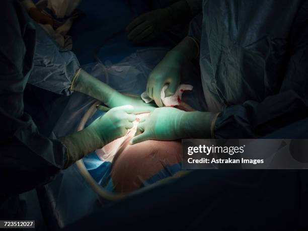 surgeons performing caesarean section in operating room - caesarean section stock pictures, royalty-free photos & images