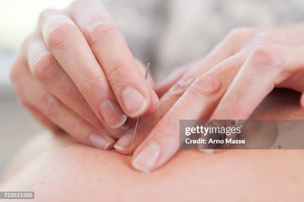 Acupuncture Hand Photos and Premium High Res Pictures - Getty Images