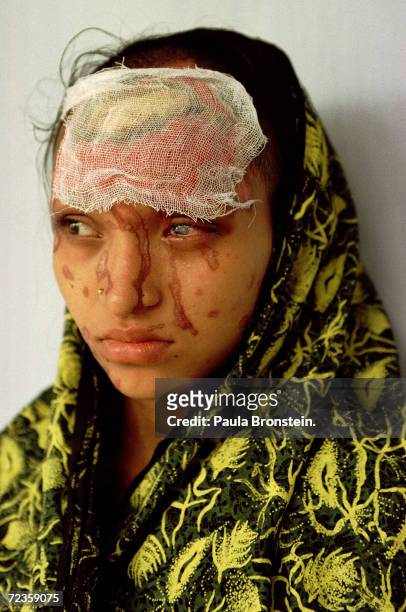 Tears run uncontrollably from Asma's eyes July 2000 in Dhaka, Bangladesh because of severe damage from a battery acid attack by her boyfriend two...