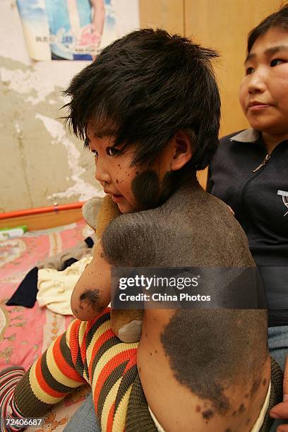 Four-year-old Chinese girl Jiaxue, who suffers from hairy black moles, sits on a bed at home November 4, 2006 in Changchun of Jilin Province, China....